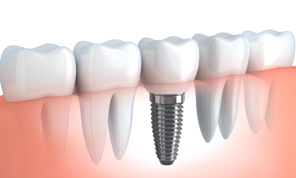 types implants dentaires
